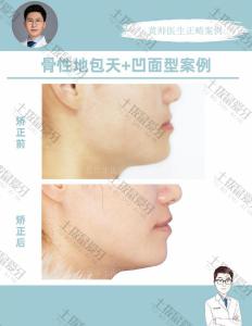 骨性地包天，凹面型矫正案例