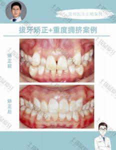 牙齿重度拥挤矫正案例