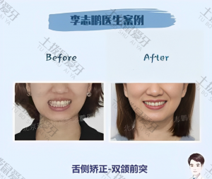 双颌前突，舌侧矫正案例