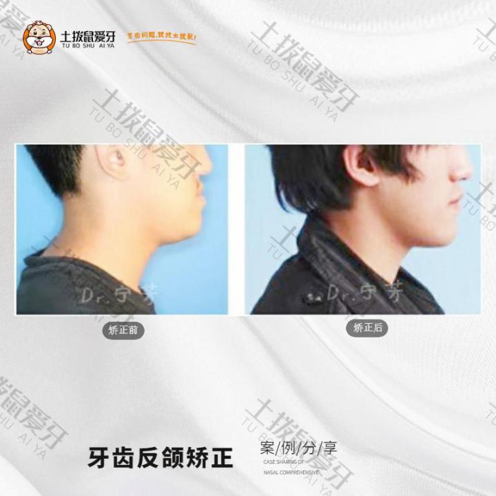 地包天导致下巴前伸矫正案例