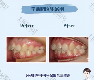 深覆盖、深覆合跟牙弓狭窄矫正案例