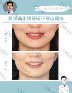 牙齿拥挤，隐形矫正案例