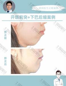 开颌前突、下巴后缩矫正案例