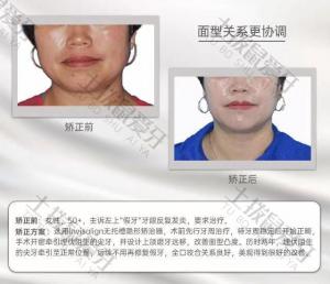 50岁成人女性埋伏阻生牙牵引矫正案例