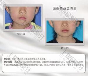 9岁儿童牙齿早期干预矫正案例