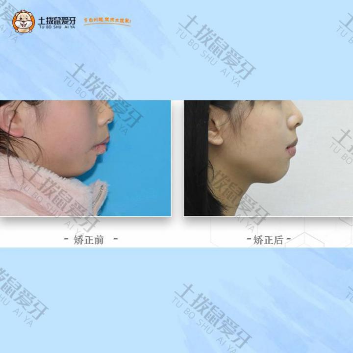 青少年牙齿外凸深覆盖矫正案例