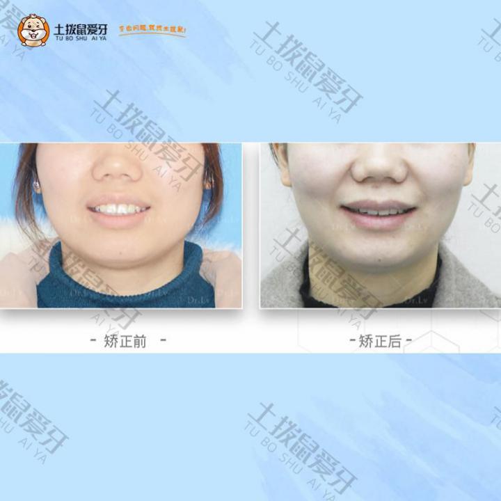 30岁成人牙齿外凸矫正案例