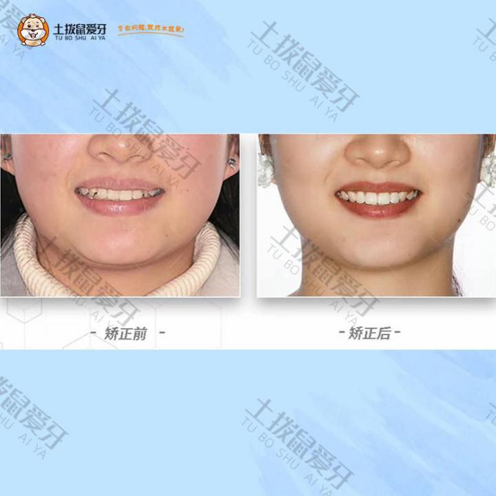 成人牙齿不齐深覆合牙齿矫正案例