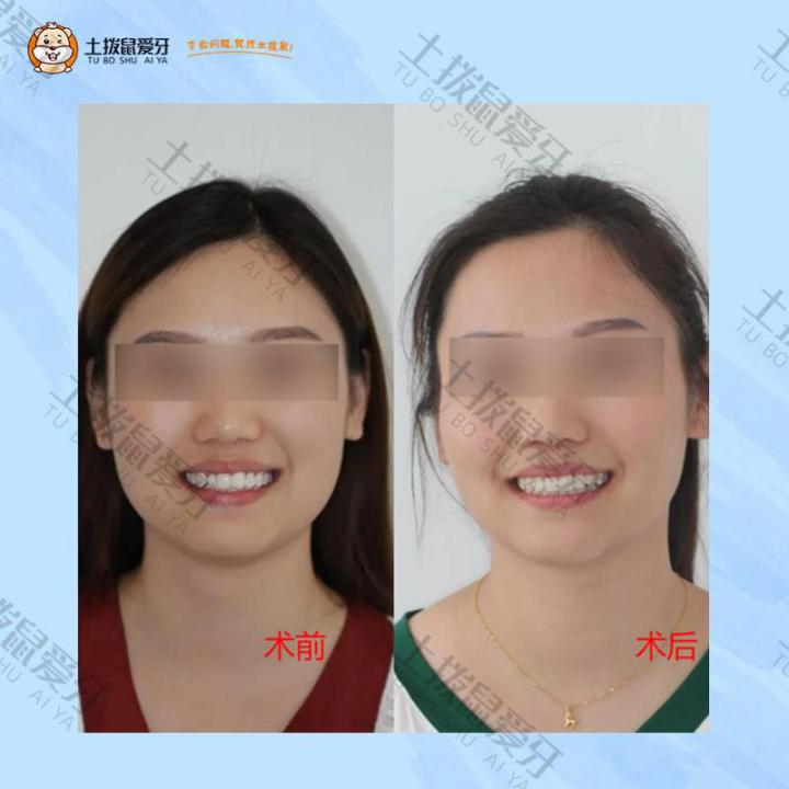 单牙反颌，牙齿矫正案例