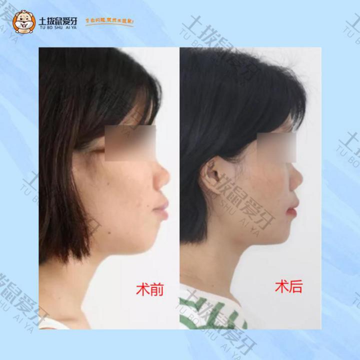 重度牙周炎，牙齿前突矫正案例