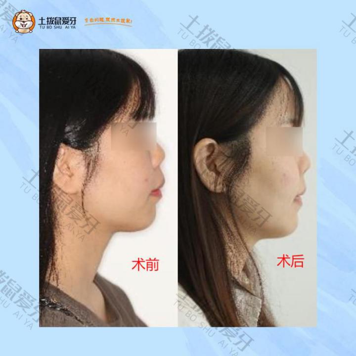 骨性前突牙齿矫正案例