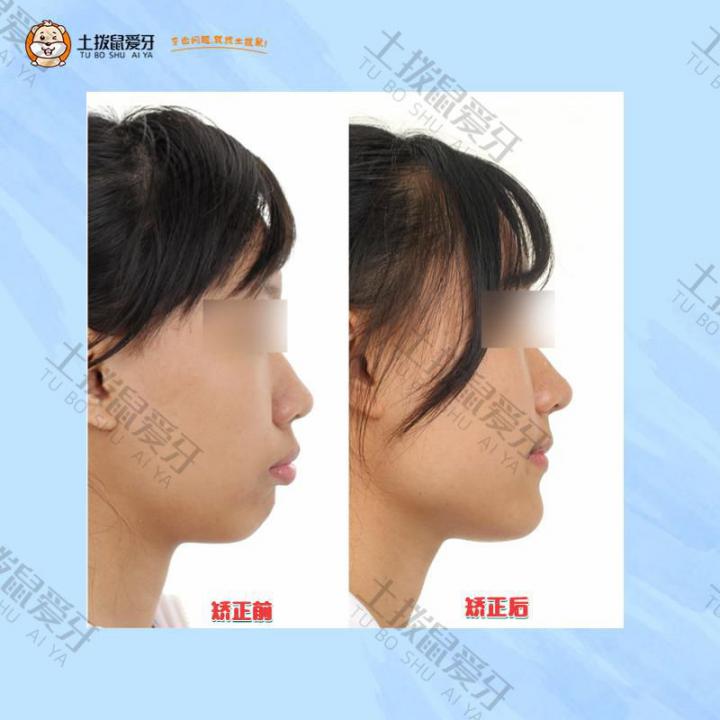 凸嘴，下巴后缩矫正案例