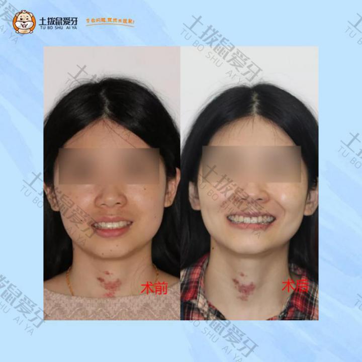 上牙前突，下巴后缩，牙齿矫正案例