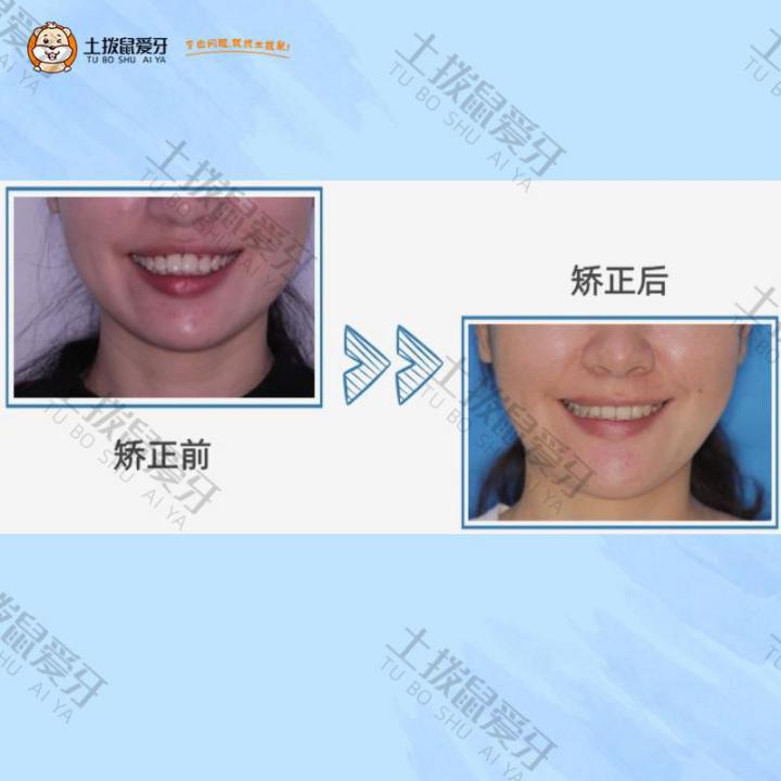 深覆盖，牙齿不齐矫正案例