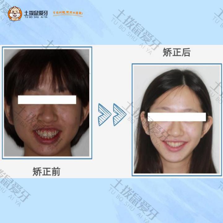 青少年牙齿外凸矫正案例