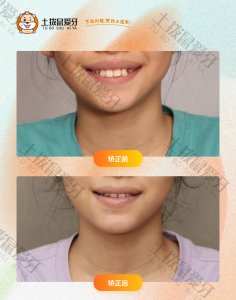 女孩替牙期牙齿上突下缩，嘴突、露龈笑
