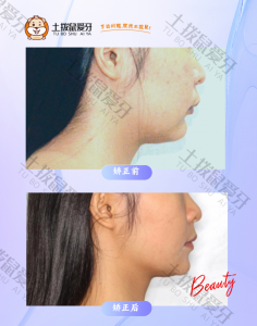 女士侧面小下巴，深覆盖正畸案例