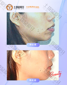 女士凸面型，嘴凸龅牙正畸案例