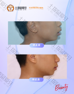 男生深覆合+深覆盖矫正案例