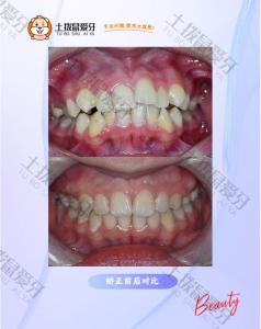 牙齿不齐金属矫正
