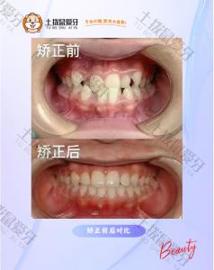 反颌+虎牙突出+中线不齐矫正案例