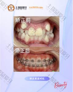 偏颌+虎牙突出+中线不齐矫正