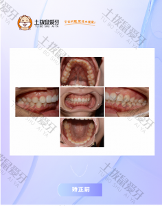 严重的骨性二类前突矫正