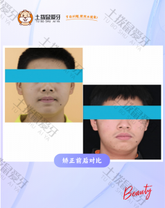 上颌前突，下巴后缩矫治案例