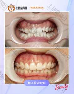 成人女性嘴突，牙不齐，内抠