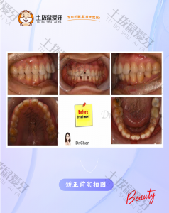门牙缝隙 案例