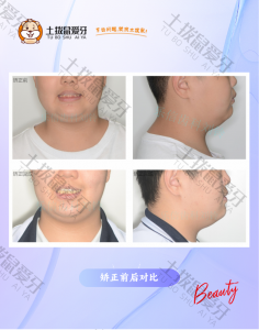 隐形矫正 龅牙 非拔牙案例