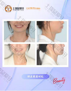 面型改善大 缺失牙矫正 隐形