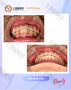 上颌前突 下颌局部舌倾