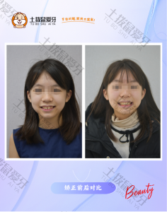 上颌中切牙扭转 外突 间隙